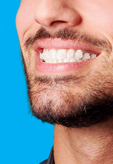 Agora você pode sorrir sem qualquer preocupação | NewONE Orthodontics