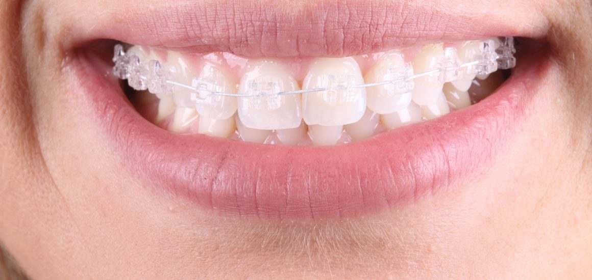 Aparelho Ortodôntico Transparente | NewONE Orthodontics