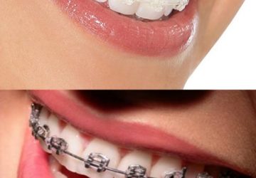 Aparelho Autoligado x Convencional: qual escolher? | NewONE Orthodontics