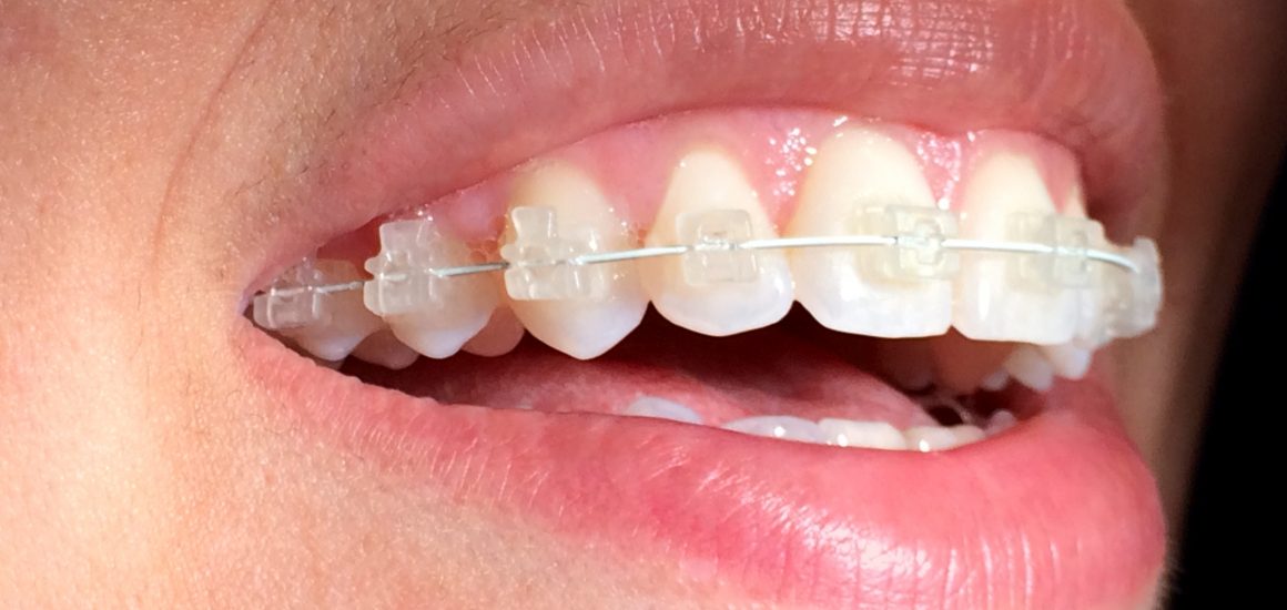 aparelho dentário | NewONE Orthodontics