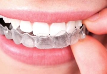 Aparelho Móvel: entenda quando é indicado | NewONE Orthodontics