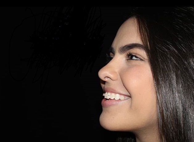 Aparelho Autoligado Transparente | NewONE Orthodontics