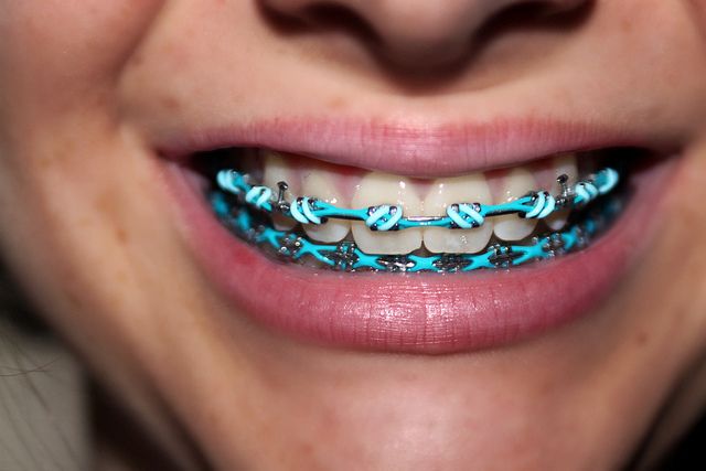 CORES DE BORRACHINHA DE APARELHO | NewONE Orthodontics