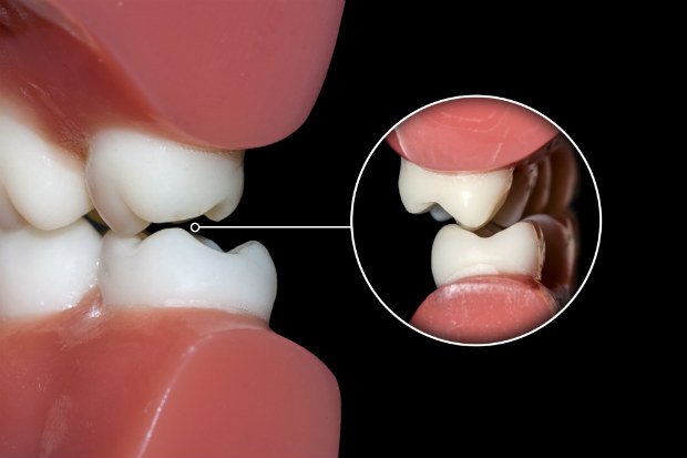 Mordida Cruzada: uma preocupação além da estética | NewONE Orthodontics