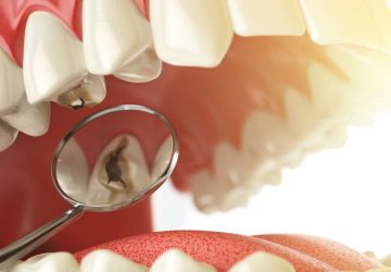 Dente com cárie atrapalha o tratamento com aparelho? | NewONE Orthodontics