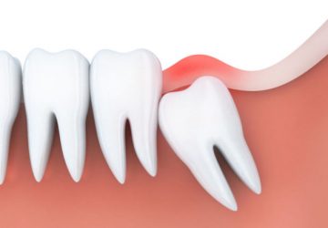 Dente do siso interfere no alinhamento dos dentes. Entenda. | NewONE Orthodontics