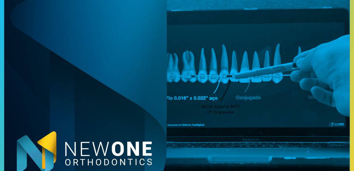 LIVE - Como utilizar a Ancoragem Esquelética no Tratamento Híbrido? | NewONE Orthodontics