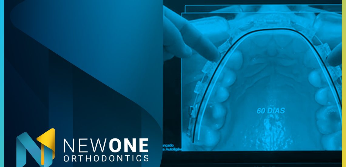 LIVE - Como o Sistema Autoligável pode potencializar a Bioadaptação? | NewONE Orthodontics